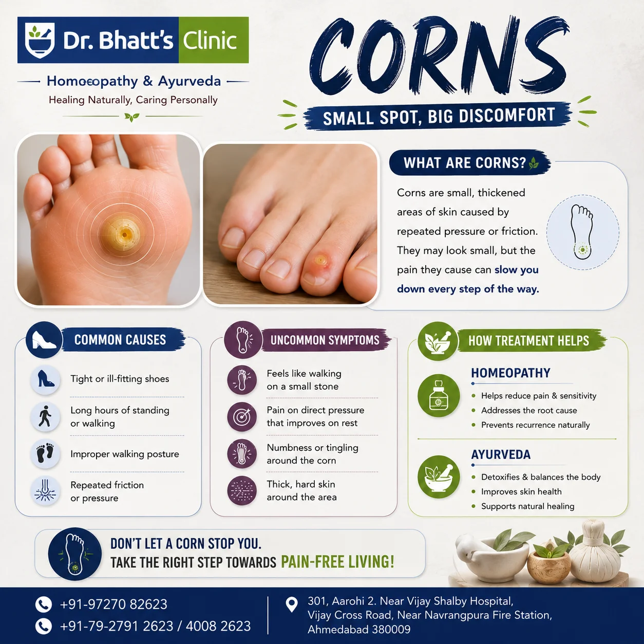 Corns (Foot Corn): Causes, Symptoms & Natural Treatment with Homoeopathy and Ayurveda